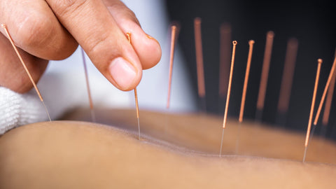 Cupping Therapy vs Acupuncture: Two Methods that Promise Pain Relief